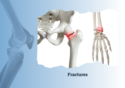 fracture first aid before hospital